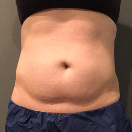Belly after CoolSculpting.
