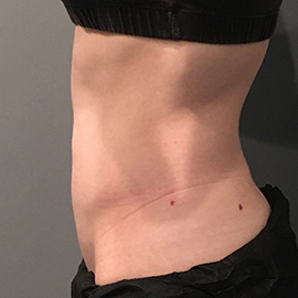 Belly after CoolSculpting.