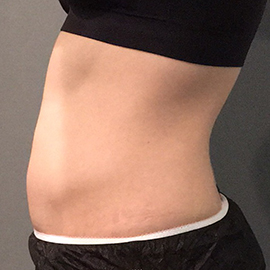 Belly before CoolSculpting.