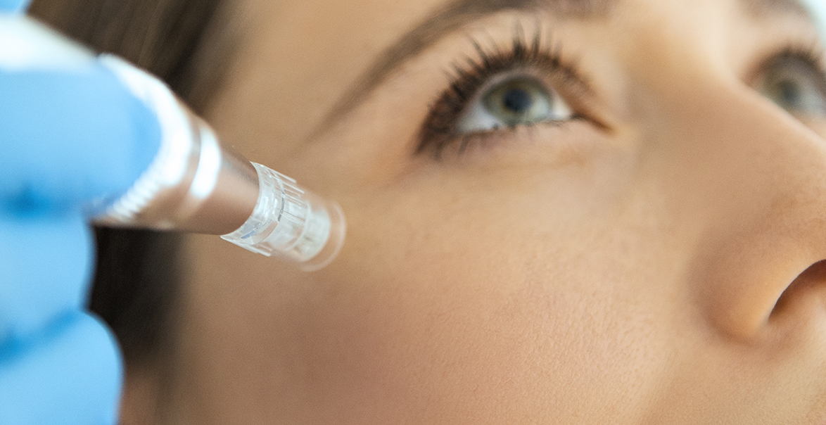 Read more about the article Discover Everything You Need to Know About Microneedling